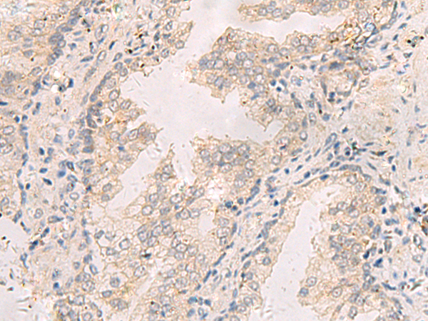 Immunohistochemistry of paraffin-embedded Human prost at e cancer tissue  using TNNT1 Polyclonal Antibody at dilution of 1:35(×200)