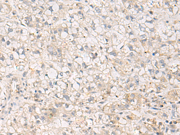 Immunohistochemistry of paraffin-embedded Human liver cancer tissue  using TNNT1 Polyclonal Antibody at dilution of 1:35(×200)