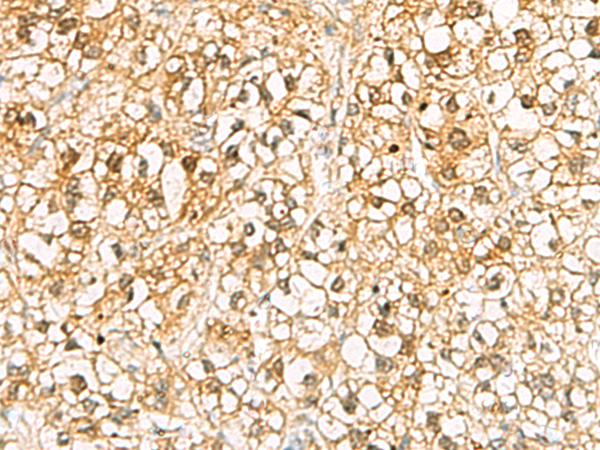 Immunohistochemistry of paraffin-embedded Human liver cancer tissue  using C11orf54 Polyclonal Antibody at dilution of 1:70(×200)