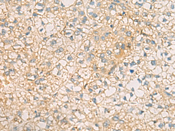 Immunohistochemistry of paraffin-embedded Human liver cancer tissue  using MRPL9 Polyclonal Antibody at dilution of 1:60(×200)