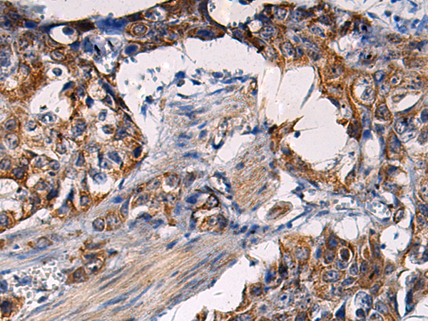 Immunohistochemistry of paraffin-embedded Human esophagus cancer tissue  using RITA1 Polyclonal Antibody at dilution of 1:50(×200)