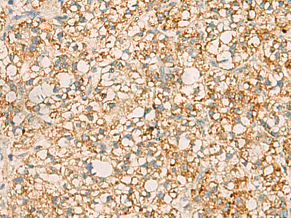 Immunohistochemistry of paraffin-embedded Human liver cancer tissue  using PDCL Polyclonal Antibody at dilution of 1:40(×200)