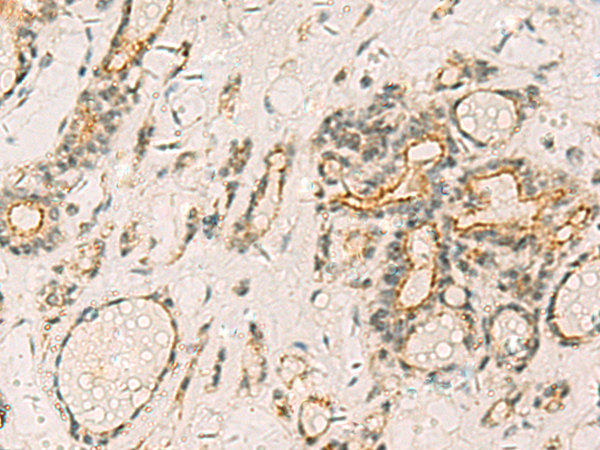 Immunohistochemistry of paraffin-embedded Human thyroid cancer tissue  using HORMAD2 Polyclonal Antibody at dilution of 1:35(×200)