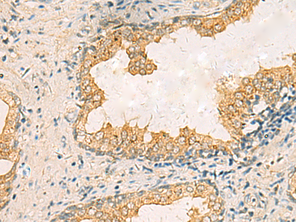 Immunohistochemistry of paraffin-embedded Human prost ate cancer tissue  using HORMAD2 Polyclonal Antibody at dilution of 1:35(×200)