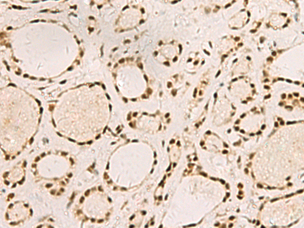 Immunohistochemistry of paraffin-embedded Human thyroid cancer tissue  using SAP30BP Polyclonal Antibody at dilution of 1:45(×200)