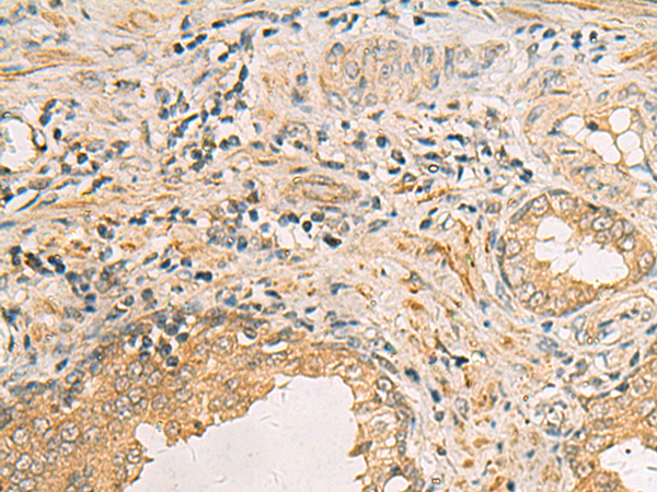 Immunohistochemistry of paraffin-embedded Human prost ate cancer tissue  using IDS Polyclonal Antibody at dilution of 1:70(×200)