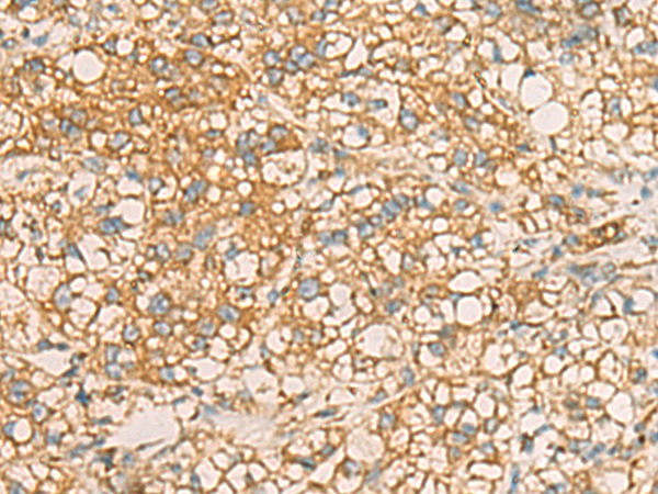Immunohistochemistry of paraffin-embedded Human liver cancer tissue  using AIMP1 Polyclonal Antibody at dilution of 1:40(×200)