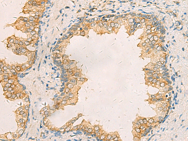 Immunohistochemistry of paraffin-embedded Human prost ate cancer tissue  using AIMP1 Polyclonal Antibody at dilution of 1:40(×200)