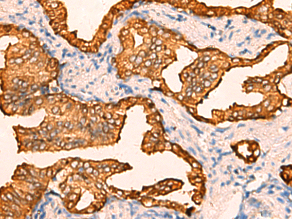 Immunohistochemistry of paraffin-embedded Human prost at e cancer tissue  using CRYM Polyclonal Antibody at dilution of 1:60(×200)