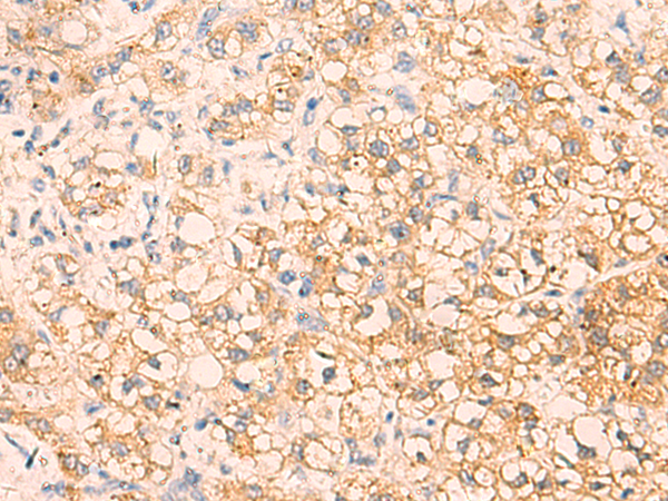 Immunohistochemistry of paraffin-embedded Human liver cancer tissue  using EPCAM Polyclonal Antibody at dilution of 1:40(×200)