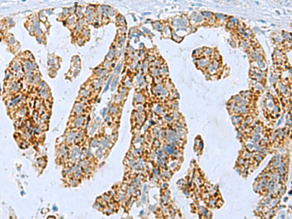 Immunohistochemistry of paraffin-embedded Human gastric cancer tissue  using PYCR2 Polyclonal Antibody at dilution of 1:35(×200)