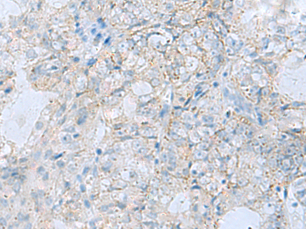 Immunohistochemistry of paraffin-embedded Human ovarian cancer tissue  using PYCR2 Polyclonal Antibody at dilution of 1:35(×200)