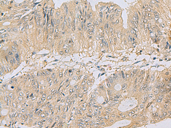 Immunohistochemistry of paraffin-embedded Human colorectal cancer tissue  using TSTA3 Polyclonal Antibody at dilution of 1:80(×200)