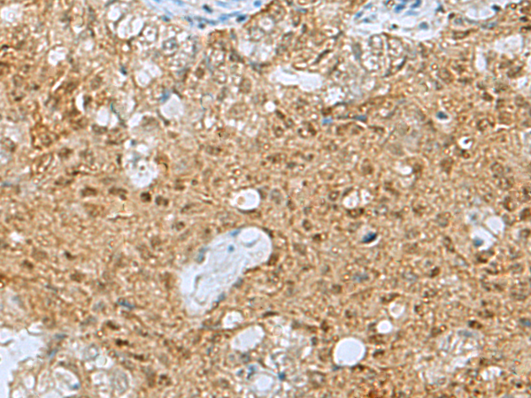 Immunohistochemistry of paraffin-embedded Human ovarian cancer tissue  using PTPA Polyclonal Antibody at dilution of 1:60(×200)