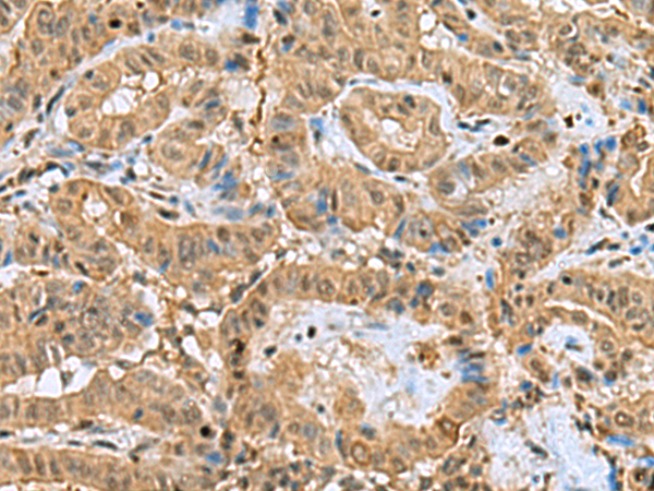 Immunohistochemistry of paraffin-embedded Human thyroid cancer tissue  using PTPA Polyclonal Antibody at dilution of 1:60(×200)