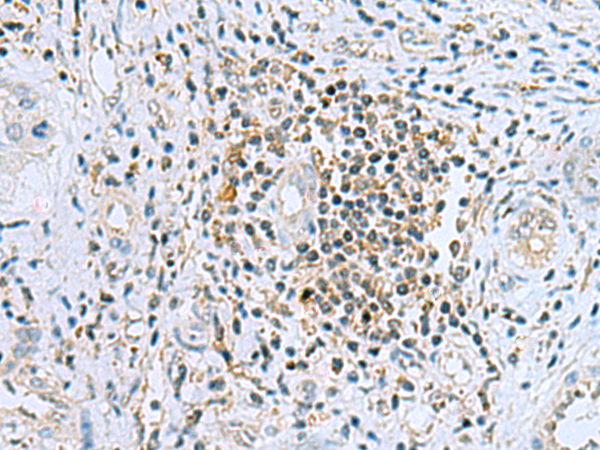 Immunohistochemistry of paraffin-embedded Human liver cancer tissue  using DHRS7B Polyclonal Antibody at dilution of 1:80(×200)