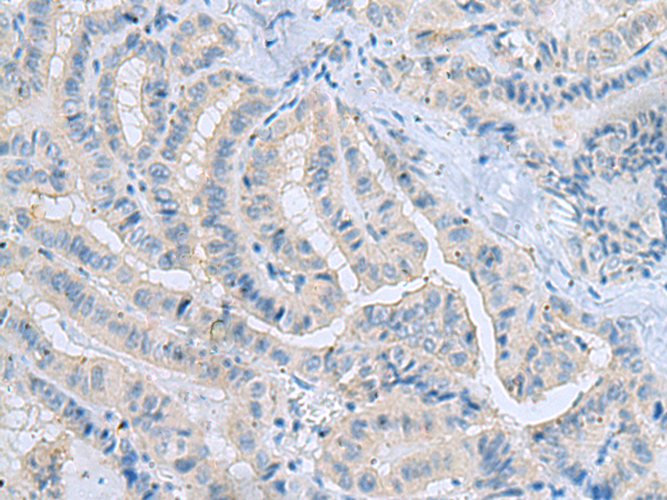 Immunohistochemistry of paraffin-embedded Human thyroid cancer tissue  using MSI2 Polyclonal Antibody at dilution of 1:70(×200)