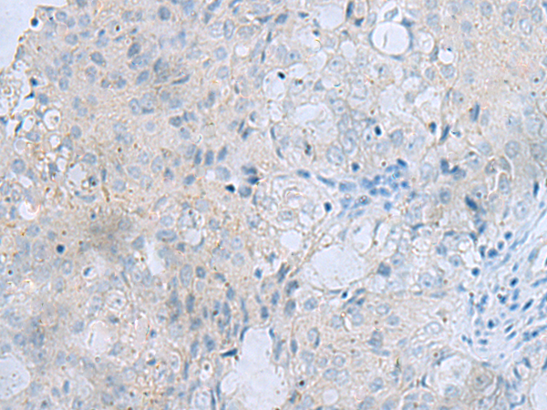 Immunohistochemistry of paraffin-embedded Human ovarian cancer tissue  using MSI2 Polyclonal Antibody at dilution of 1:70(×200)