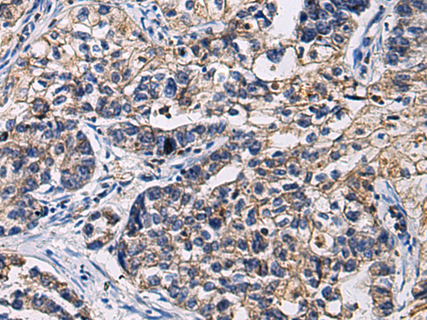 Immunohistochemistry of paraffin-embedded Human gastric cancer tissue  using SSH3 Polyclonal Antibody at dilution of 1:55(×200)