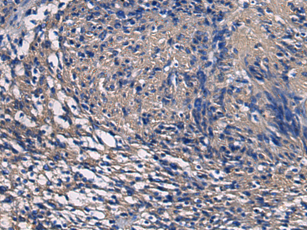 Immunohistochemistry of paraffin-embedded Human brain tissue  using SSH3 Polyclonal Antibody at dilution of 1:55(×200)