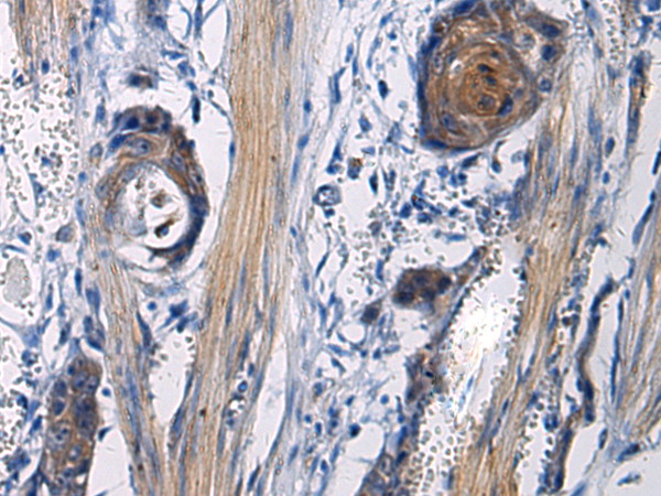 Immunohistochemistry of paraffin-embedded Human esophagus cancer tissue  using ICA1 Polyclonal Antibody at dilution of 1:50(×200)