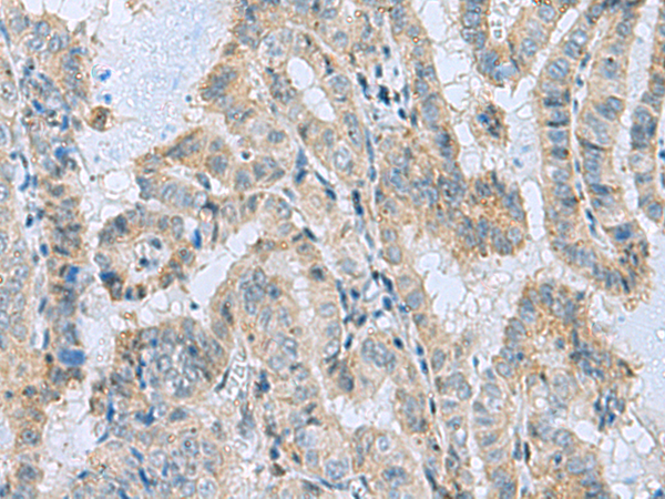 Immunohistochemistry of paraffin-embedded Human thyroid cancer tissue  using MGME1 Polyclonal Antibody at dilution of 1:50(×200)