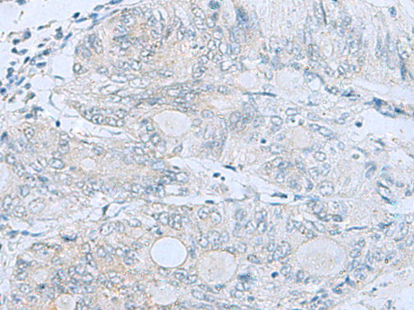 Immunohistochemistry of paraffin-embedded Human colorectal cancer tissue  using MGME1 Polyclonal Antibody at dilution of 1:50(×200)