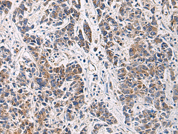 Immunohistochemistry of paraffin-embedded Human colorectal cancer tissue  using HSDL2 Polyclonal Antibody at dilution of 1:80(×200)