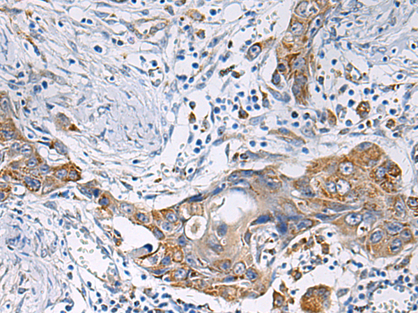 Immunohistochemistry of paraffin-embedded Human esophagus cancer tissue  using HSDL2 Polyclonal Antibody at dilution of 1:80(×200)