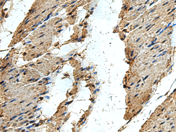 Immunohistochemistry of paraffin-embedded Human thyroid cancer tissue  using ERLIN1 Polyclonal Antibody at dilution of 1:50(×200)