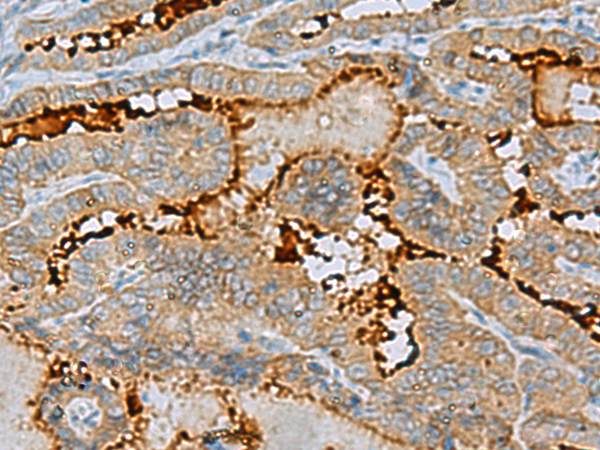 Immunohistochemistry of paraffin-embedded Human thyroid cancer tissue  using ENKD1 Polyclonal Antibody at dilution of 1:75(×200)