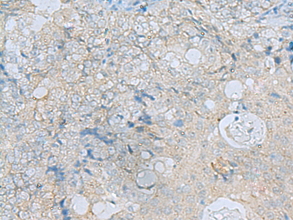 Immunohistochemistry of paraffin-embedded Human ovarian cancer tissue  using ENKD1 Polyclonal Antibody at dilution of 1:75(×200)