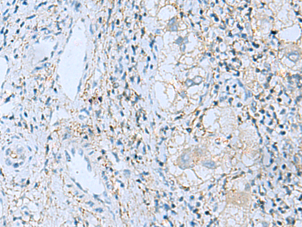 Immunohistochemistry of paraffin-embedded Human liver cancer tissue  using EMILIN1 Polyclonal Antibody at dilution of 1:55(×200)