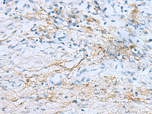 Immunohistochemistry of paraffin-embedded Human prost ate cancer tissue  using EMILIN1 Polyclonal Antibody at dilution of 1:55(×200)