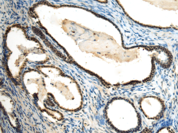 Immunohistochemistry of paraffin-embedded Human prost at e cancer tissue  using SUV39H2 Polyclonal Antibody at dilution of 1:70(×200)