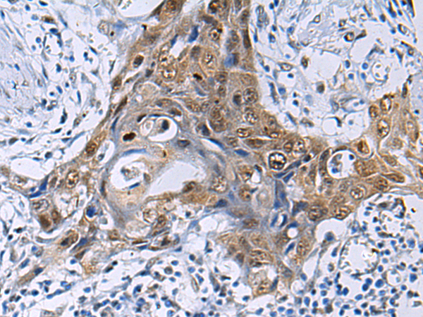 Immunohistochemistry of paraffin-embedded Human esophagus cancer tissue  using THOC3 Polyclonal Antibody at dilution of 1:50(×200)