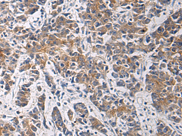 Immunohistochemistry of paraffin-embedded Human colorectal cancer tissue  using TMOD3 Polyclonal Antibody at dilution of 1:60(×200)