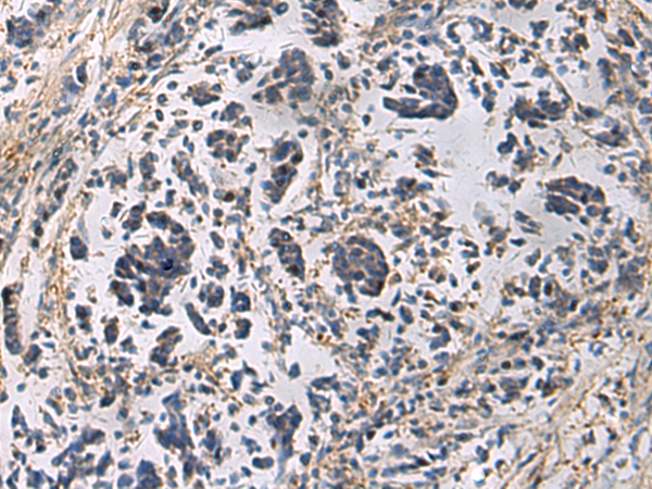 Immunohistochemistry of paraffin-embedded Human breast cancer tissue  using GRIK2 Polyclonal Antibody at dilution of 1:60(×200)