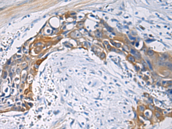 Immunohistochemistry of paraffin-embedded Human esophagus cancer tissue  using CEP89 Polyclonal Antibody at dilution of 1:100(×200)