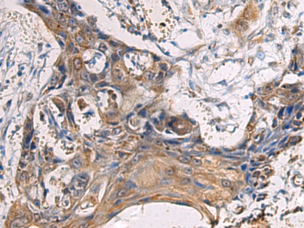 Immunohistochemistry of paraffin-embedded Human esophagus cancer tissue  using CYTIP Polyclonal Antibody at dilution of 1:100(×200)