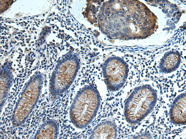 Immunohistochemistry of paraffin-embedded Human colorectal cancer tissue  using FCRLA Polyclonal Antibody at dilution of 1:80(×200)