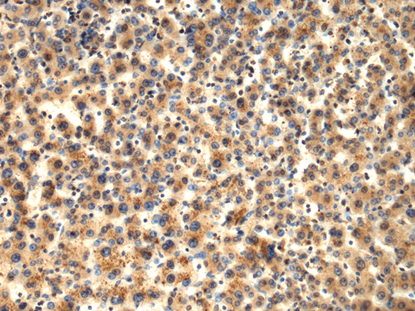 Immunohistochemistry of paraffin-embedded Human liver cancer tissue  using TMOD1 Polyclonal Antibody at dilution of 1:65(×200)