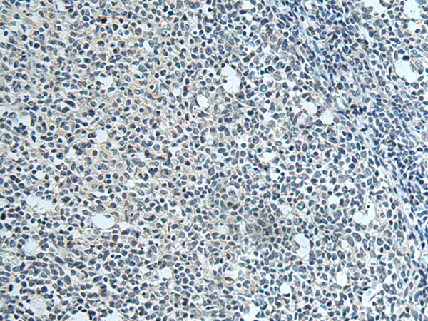 Immunohistochemistry of paraffin-embedded Human tonsil tissue  using SLC35F6 Polyclonal Antibody at dilution of 1:115(×200)