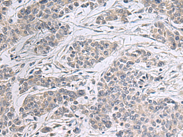 Immunohistochemistry of paraffin-embedded Human colorectal cancer tissue  using PPM1K Polyclonal Antibody at dilution of 1:55(×200)