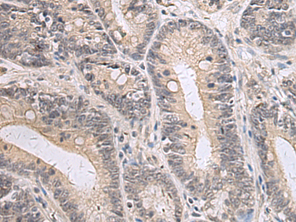 Immunohistochemistry of paraffin-embedded Human gastric cancer tissue  using PPM1K Polyclonal Antibody at dilution of 1:55(×200)