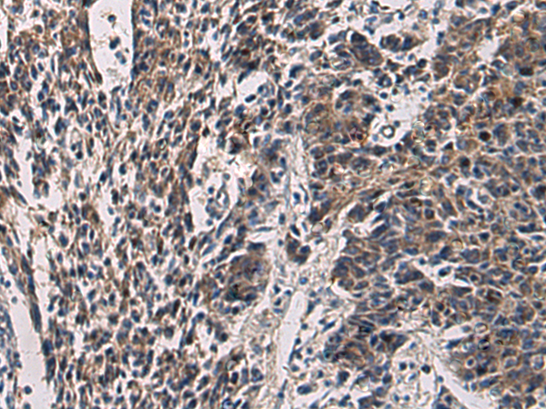 Immunohistochemistry of paraffin-embedded Human colorectal cancer tissue  using CCNI Polyclonal Antibody at dilution of 1:60(×200)