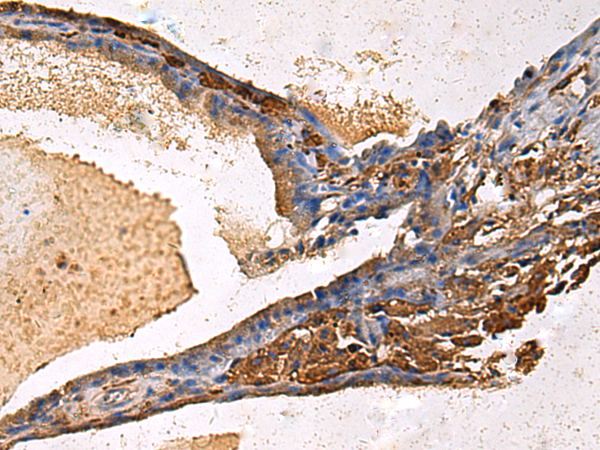 Immunohistochemistry of paraffin-embedded Human thyroid cancer tissue  using LYAR Polyclonal Antibody at dilution of 1:60(×200)