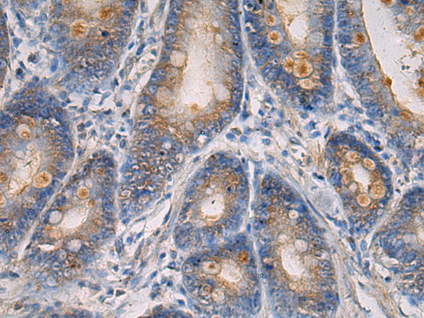 Immunohistochemistry of paraffin-embedded Human gastric cancer tissue  using MAPKAPK3 Polyclonal Antibody at dilution of 1:60(×200)