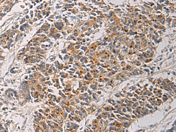 Immunohistochemistry of paraffin-embedded Human colorectal cancer tissue  using MAPKAPK3 Polyclonal Antibody at dilution of 1:60(×200)