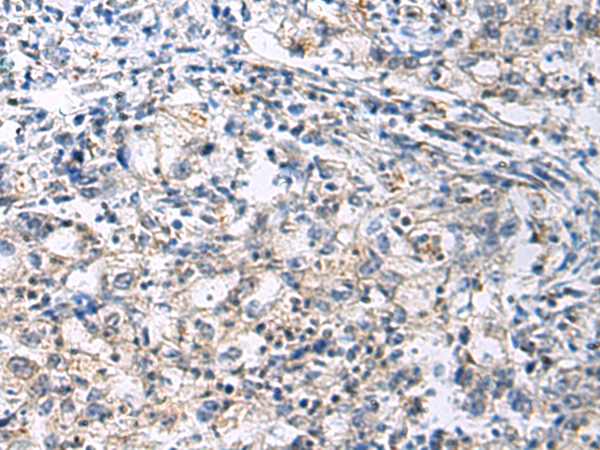 Immunohistochemistry of paraffin-embedded Human gastric cancer tissue  using SLC30A3 Polyclonal Antibody at dilution of 1:70(×200)